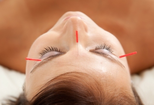 Anti-aging acupuncture treatment on young attractive female pati